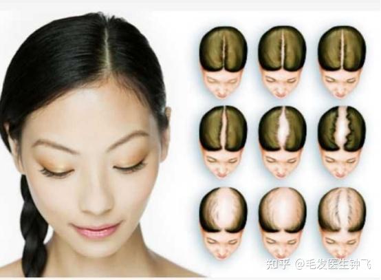 女性头顶稀疏，发缝宽是什么原因，要怎样改善? - 知乎