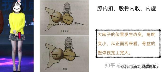 的正常前倾角是15度,由于股骨内旋导致前倾角变小,从而骨盆宽度增加