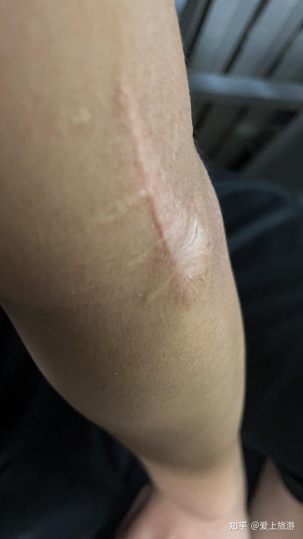 手臂伤疤照片胳膊图片