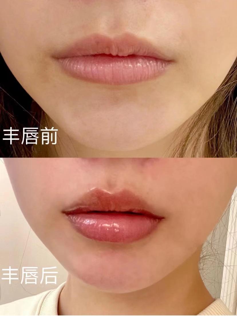 乔雅登瑞蓝伊婉润百颜玻尿酸有什么作用适合用在哪些部位价格贵吗