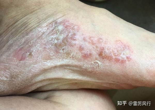 脚底同一个地方反复起水泡怎么办?