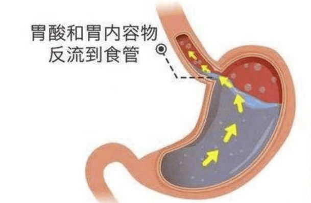胃食管反流病对症治疗才有效！（建议收藏） - 知乎