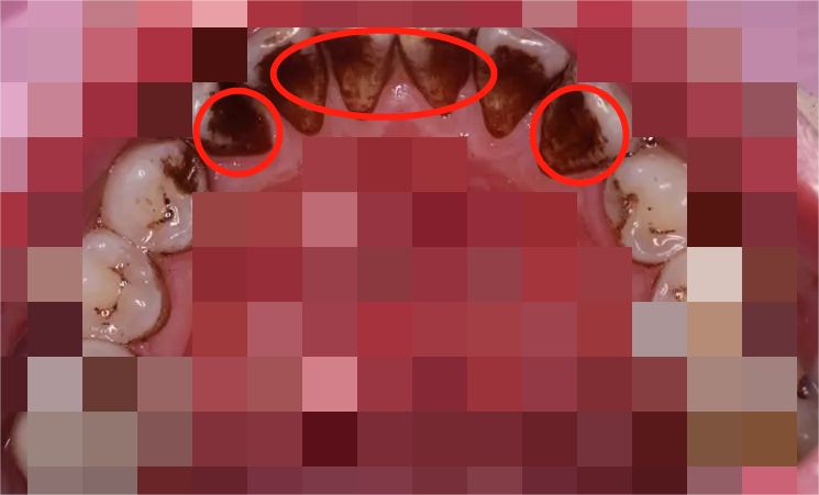 男生烟牙齿怎么变白,去烟渍,就学这2招就行了!