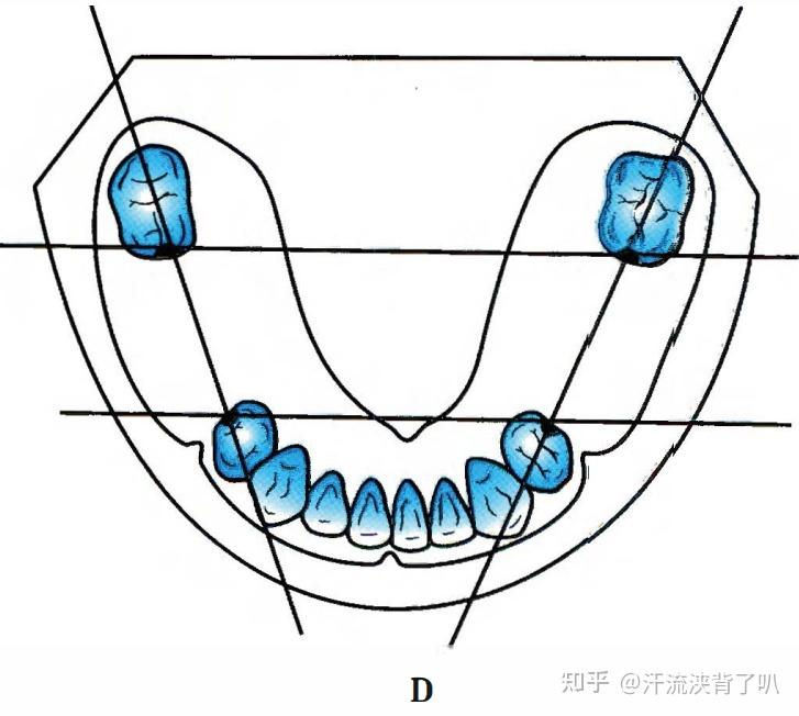 每天一个知识点:牙列缺损的分类 - 知乎