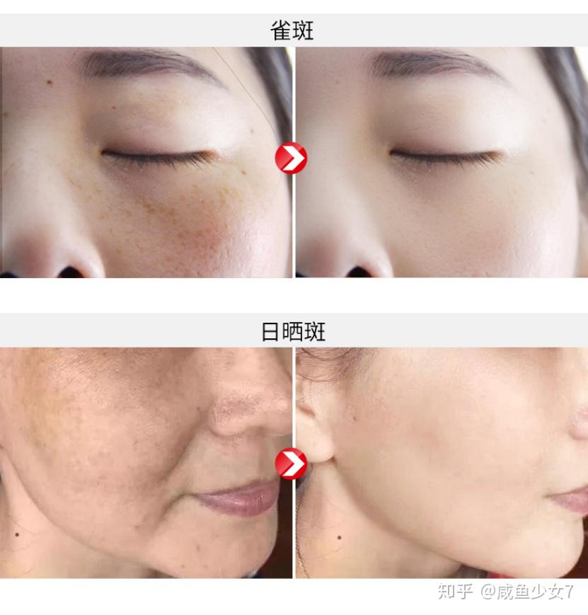 女人长斑显老祛斑很难教你一个久经考验的方法