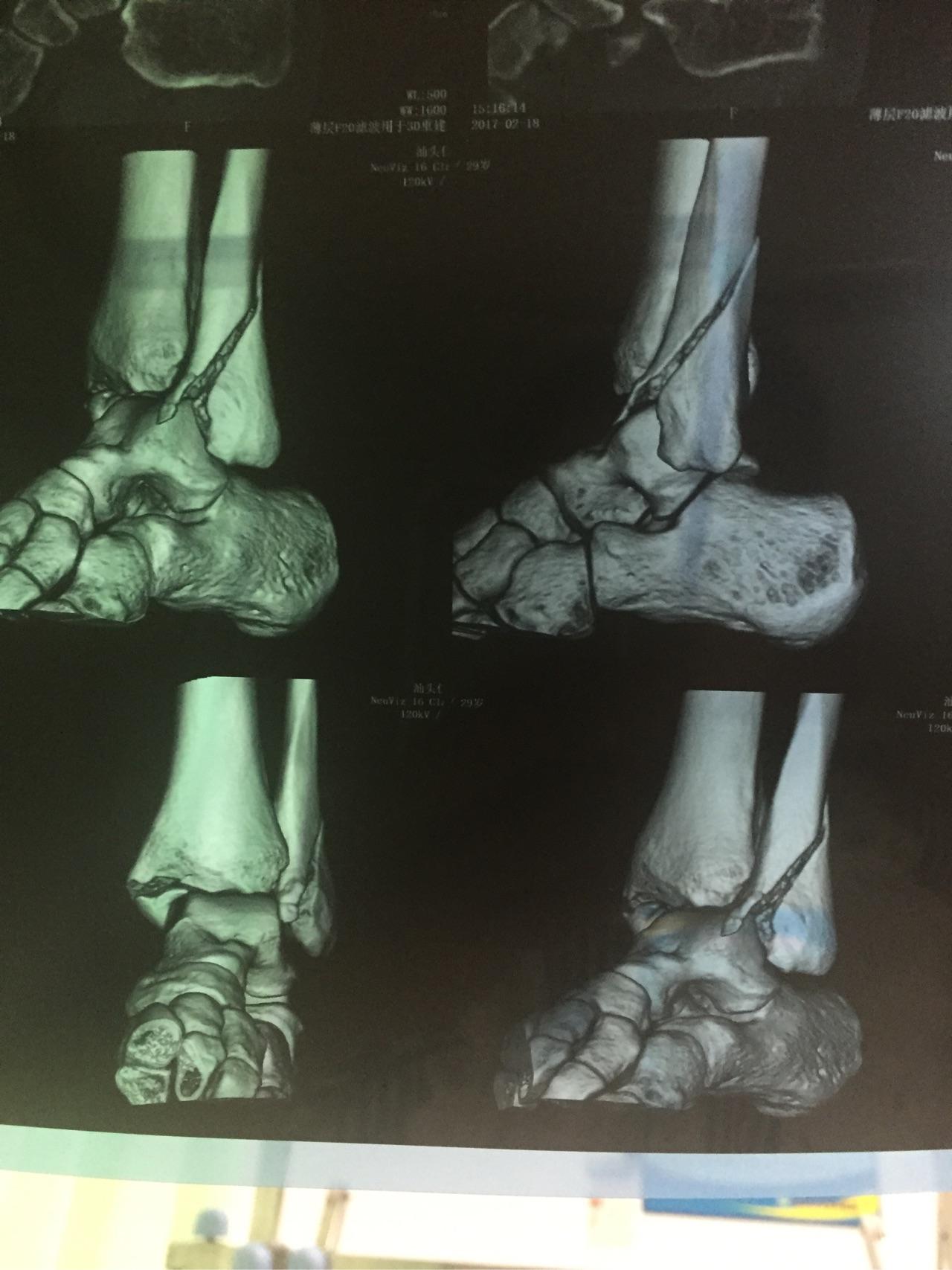 本人在17.2.16晚左脚扭伤导致内外踝骨折,到目