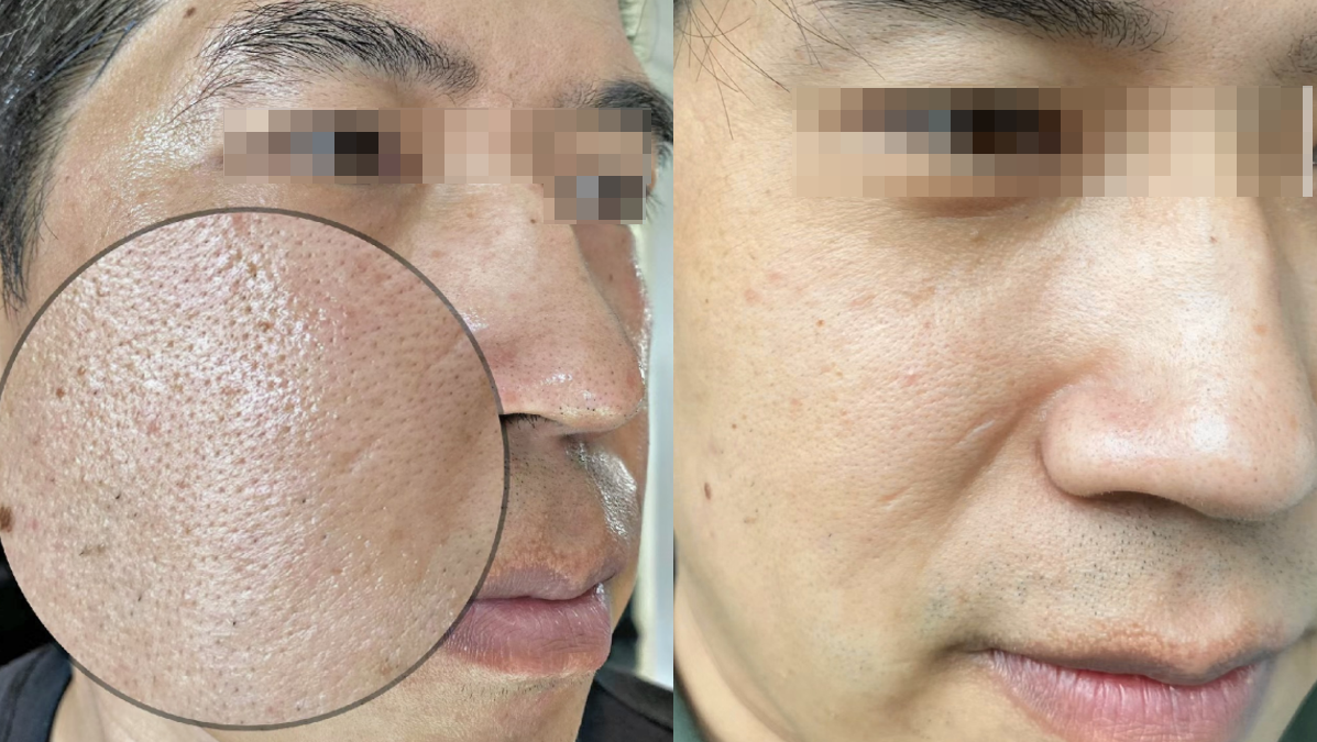 男生脸上的毛孔非常粗大,有没有什么简单的办法可以收缩毛孔? - 知乎