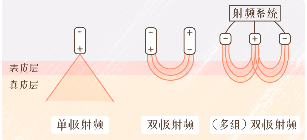 唯美德科射频仪原理图片