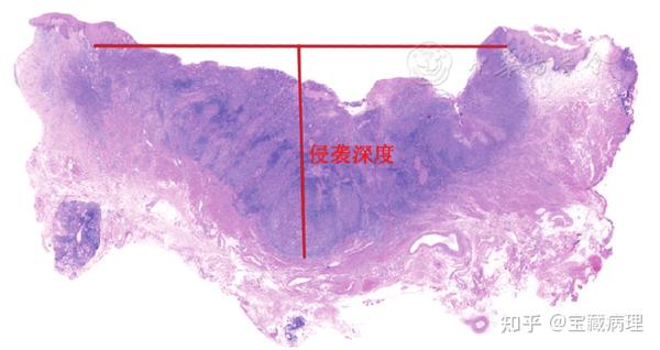 HPV相关的口咽鳞癌(OPSCC-HPV)病理诊断要点 - 知乎