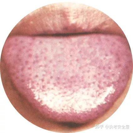 【舌诊大全】120种常见的舌苔超清彩色图谱，建议收藏！ - 知乎
