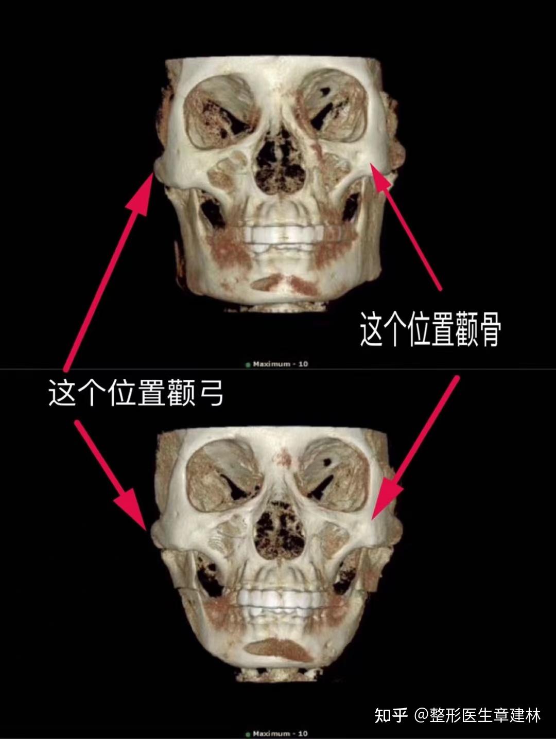下颌角截骨整形医院_下颌角截骨要多少钱_截骨下颌角官网