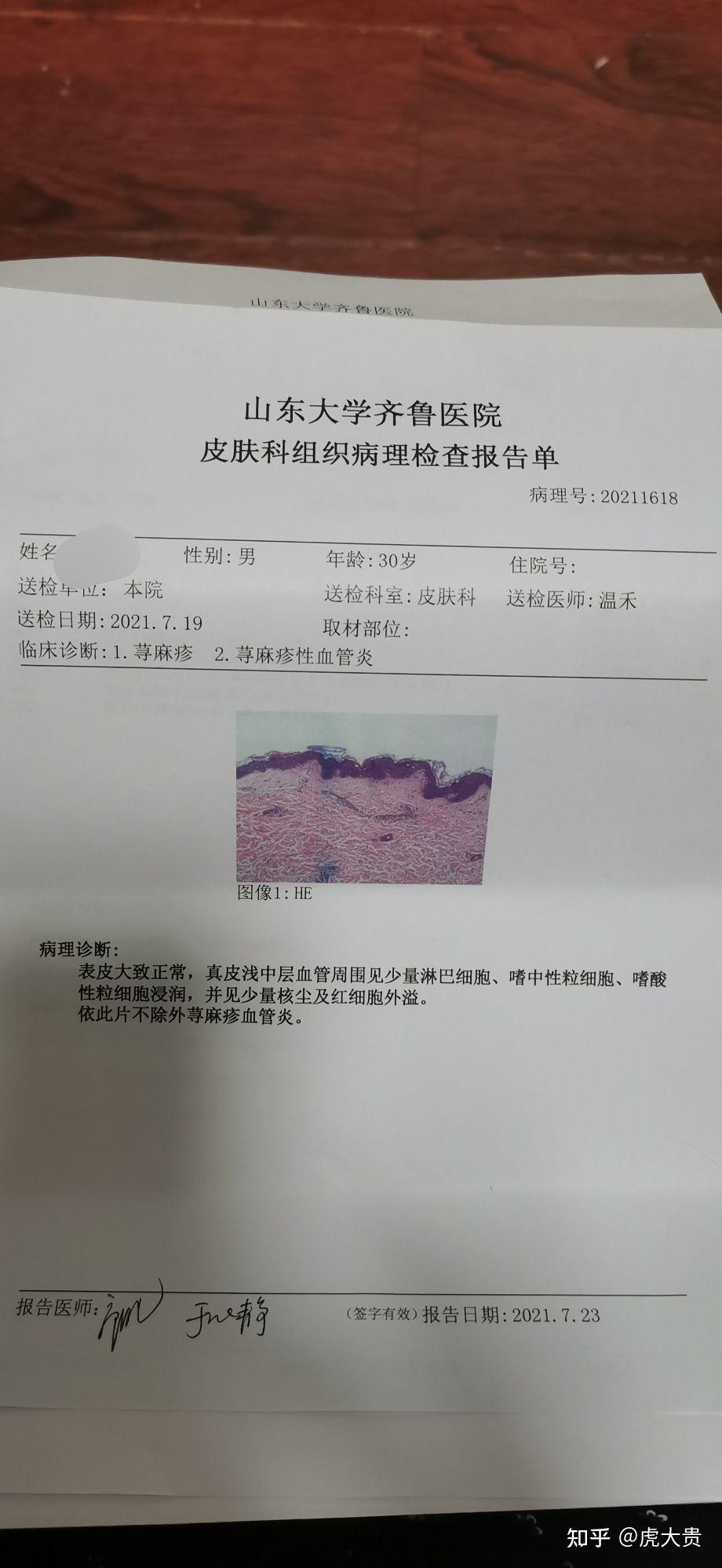 记录一下自己的荨麻疹性血管炎