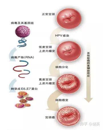 hpv感染后出现宫颈上皮内瘤变ciml如何处理