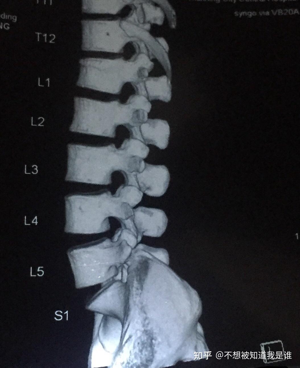 记录我女34岁的腰椎l1压缩性骨折尾椎骨折保守治疗整个恢复过程