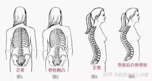 腰椎前凸角度图片