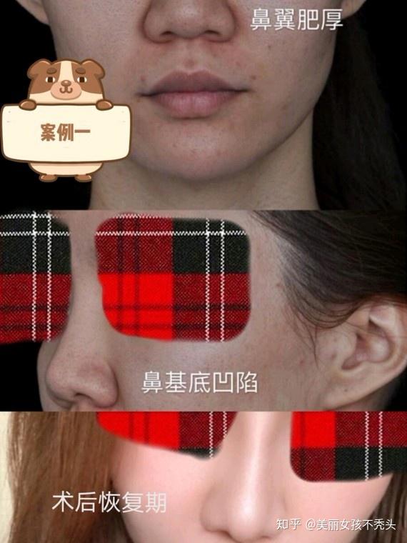 整形鼻子大概要多少钱_鼻子整形多钱_整形鼻子整形