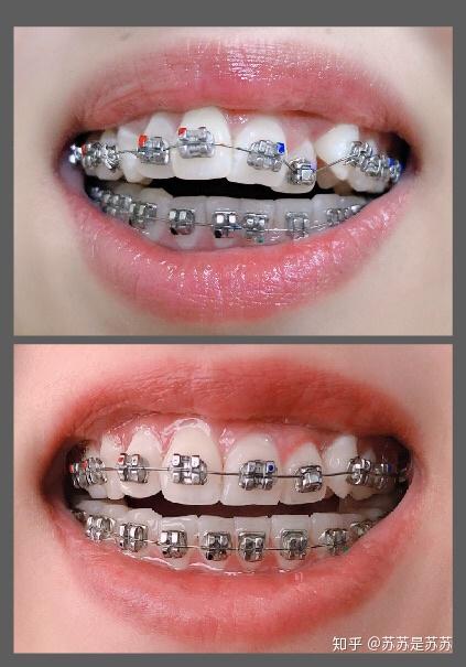天津医科大学口腔医院牙齿正畸一年更新篇