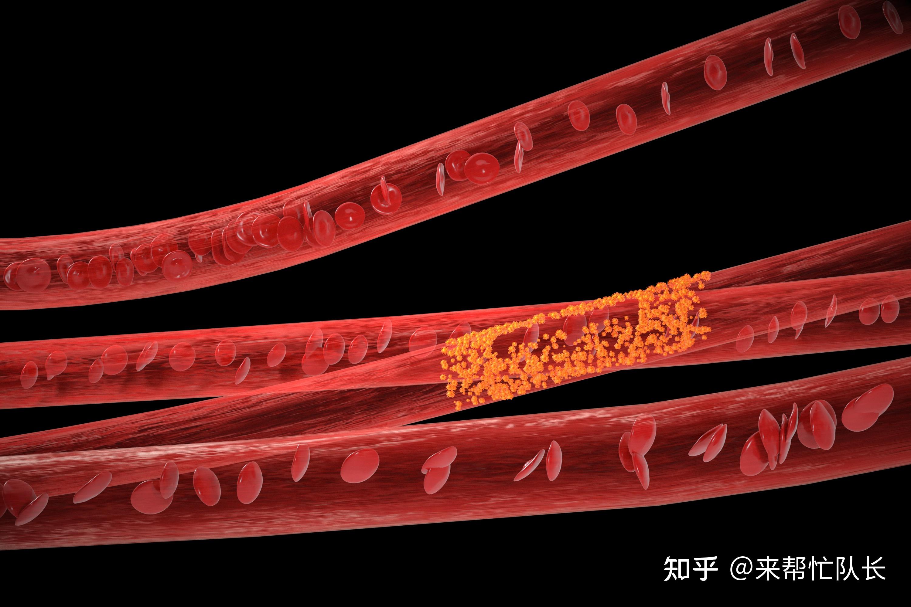 海绵状血管瘤