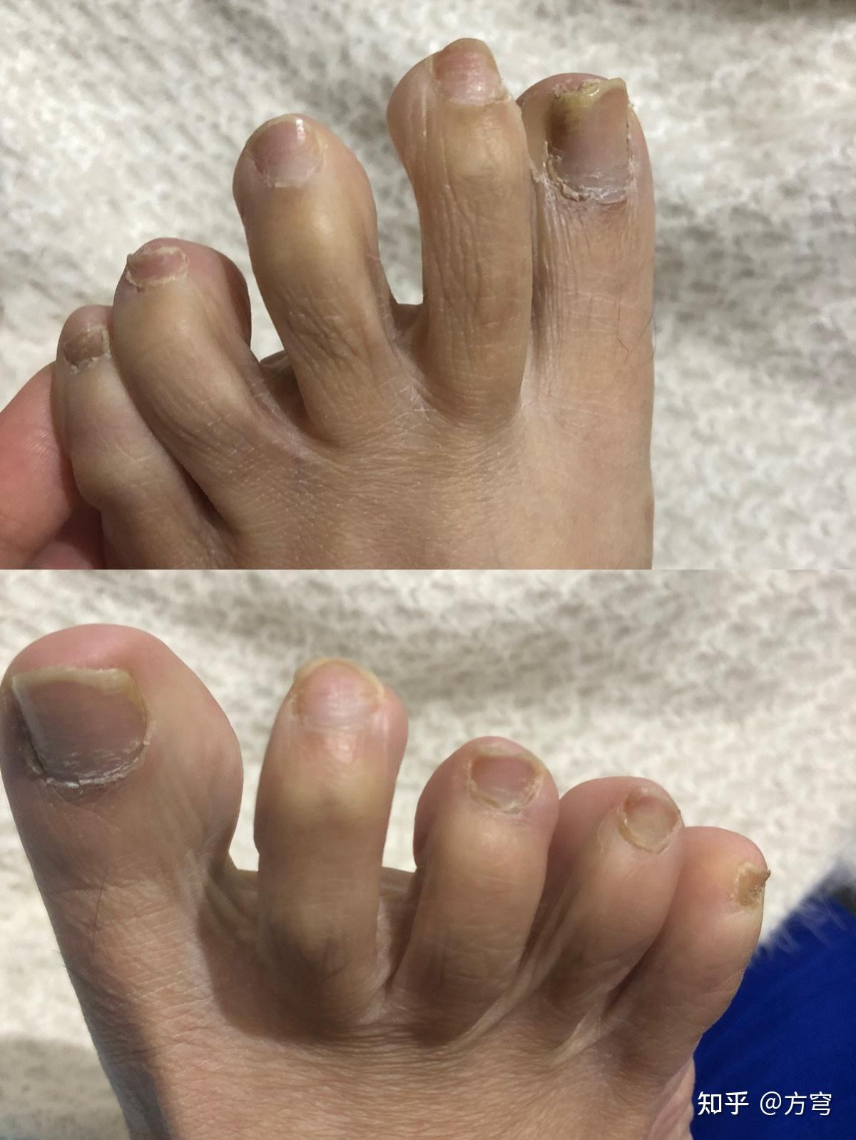 记录下灰指甲的治疗效果 - 知乎