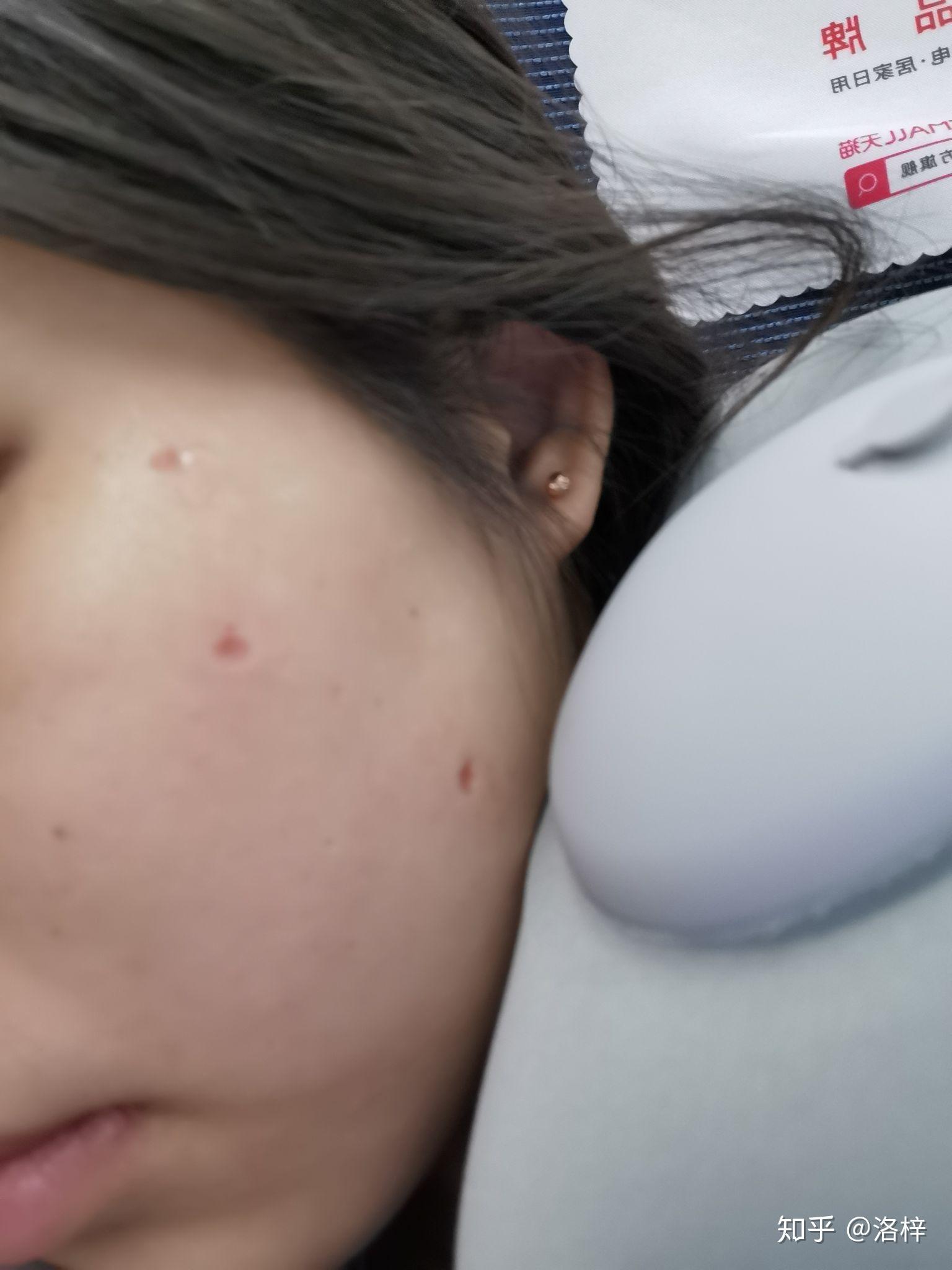 去上海九医用激光点痣