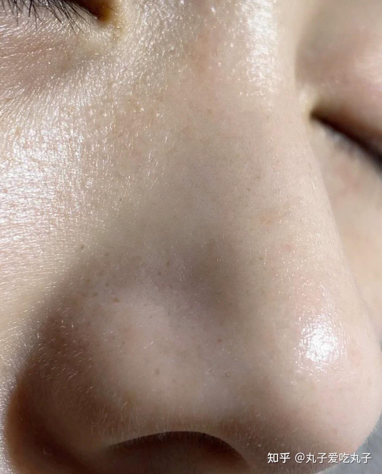 如何去除鼻子上的黑头