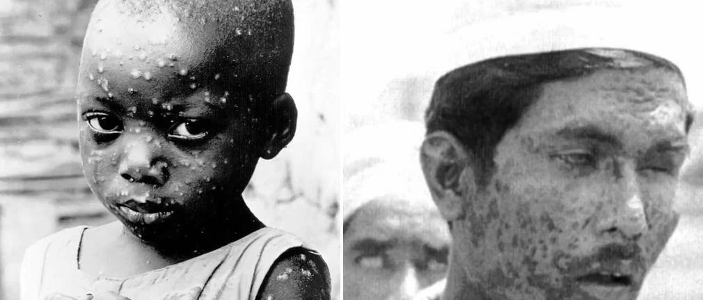 天花病毒是如何被消灭的