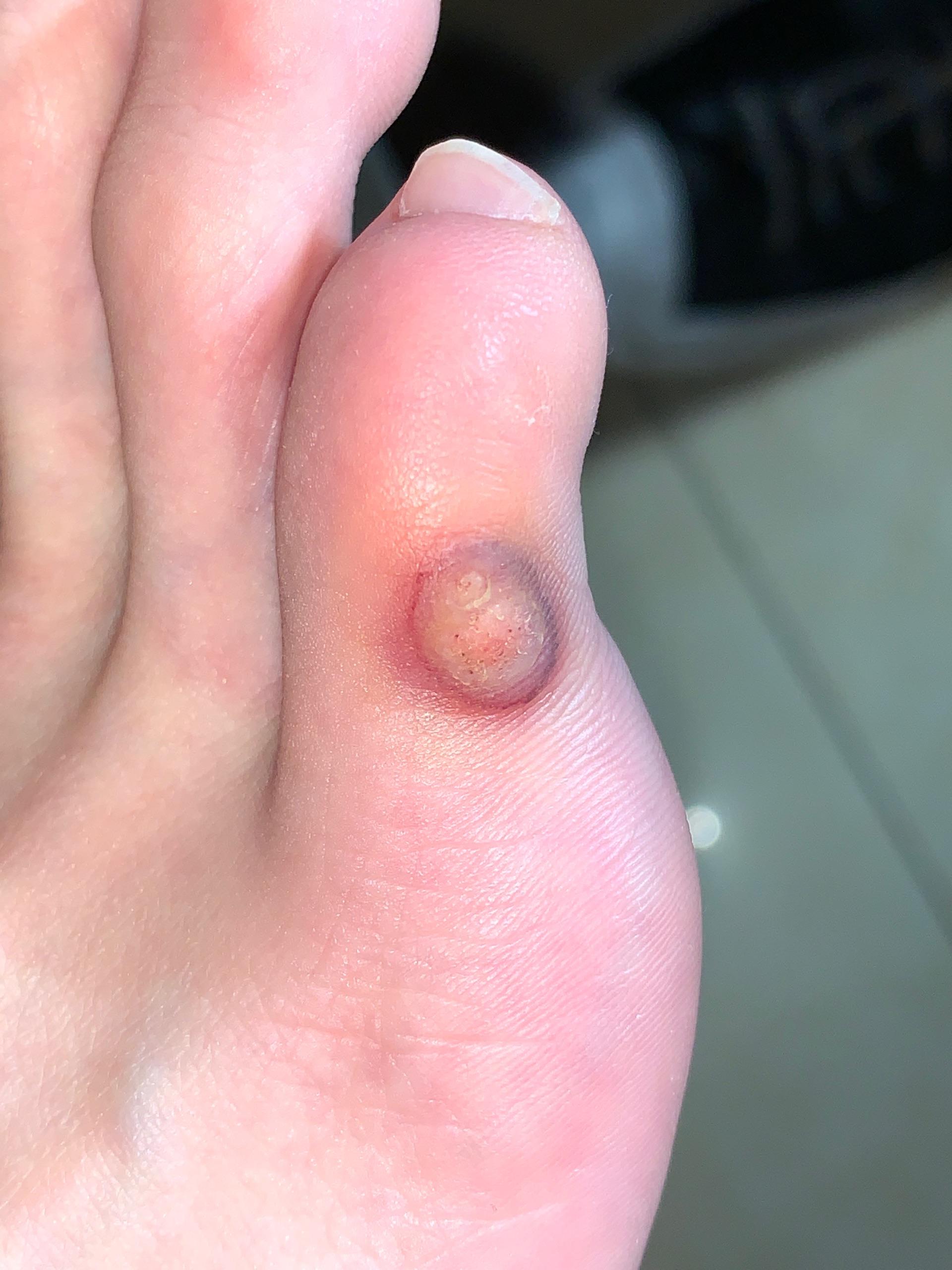 冷冻跖疣过程记录