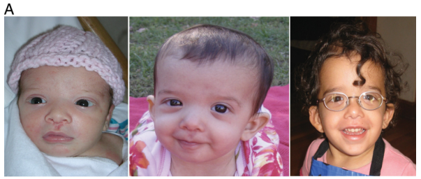 案例分享基因检测辅助罕见病诊断努南综合征