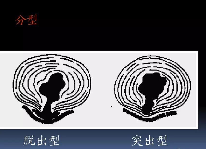 分型多发生在l4/5和l5/s1.