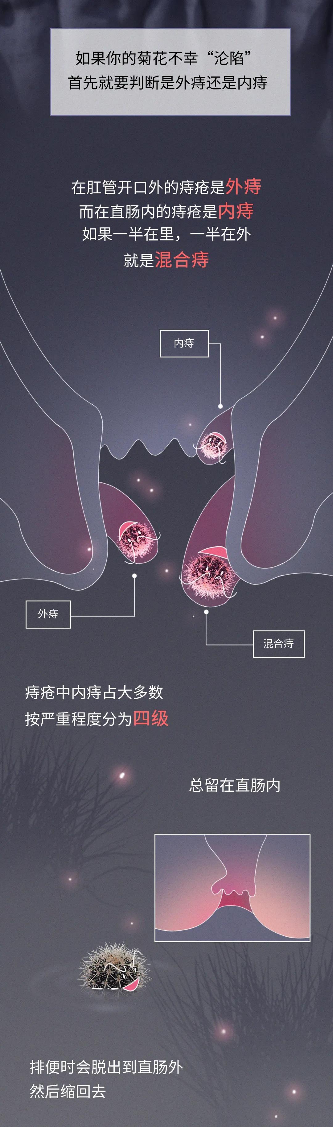 痔疮是怎么跑到你的菊花里的? - 知乎