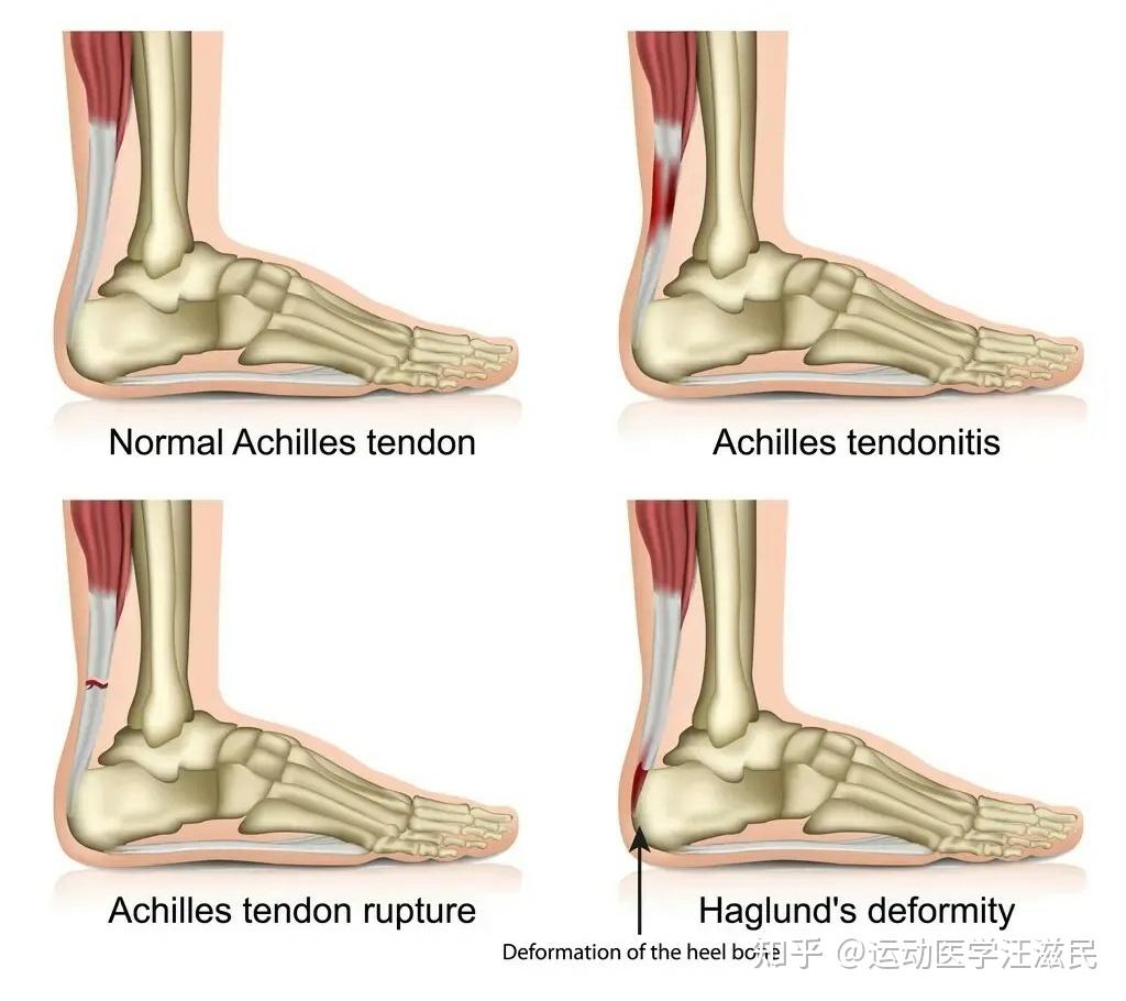 脚后跟疼是跟腱炎吗?