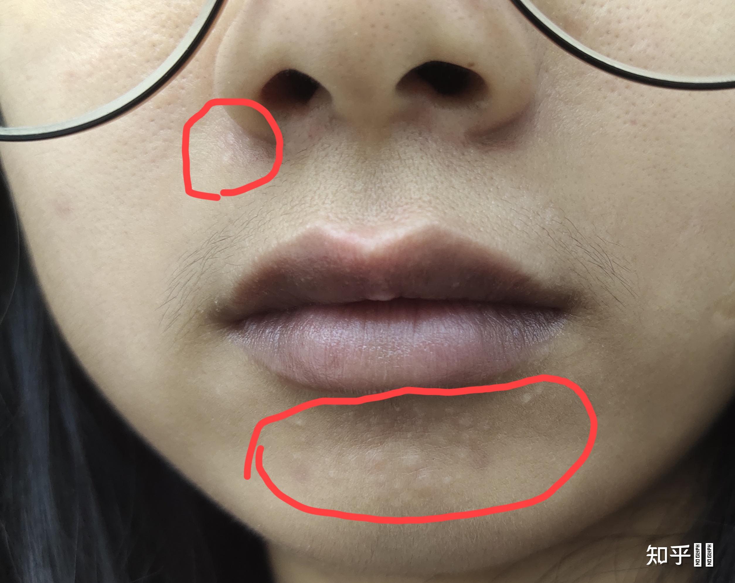 痤疮留下的疤痕凸起块,怎么办? - 知乎