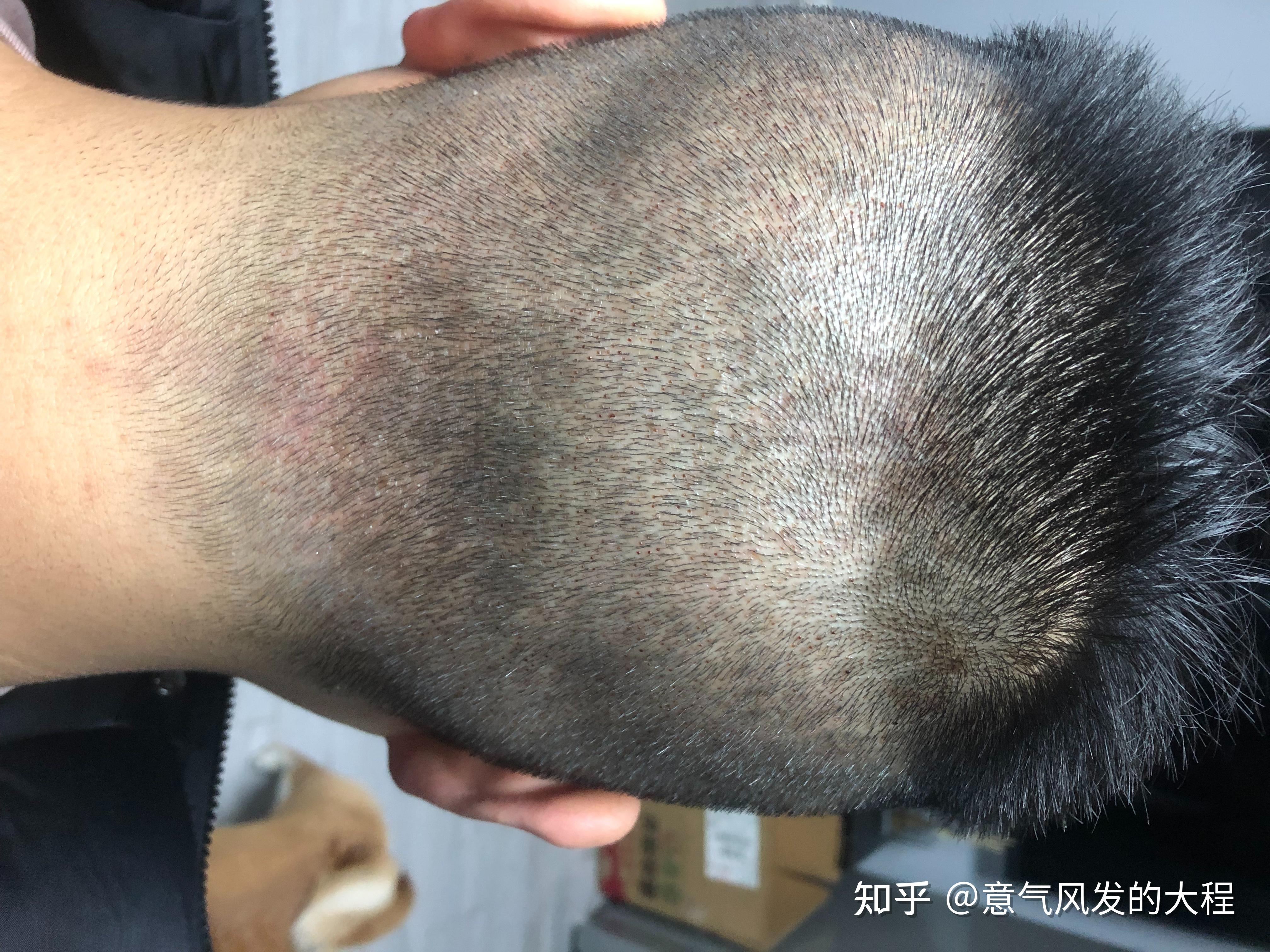 植发区域出血会失败吗(植发区流血是因为植发失败么)