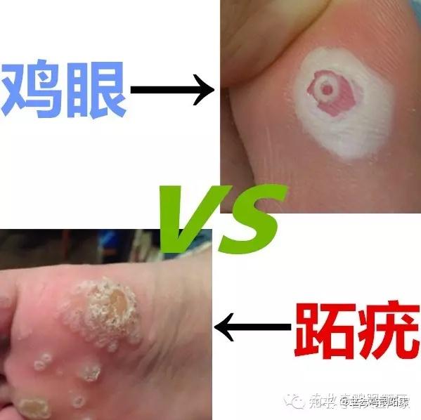 去除跖疣的办法