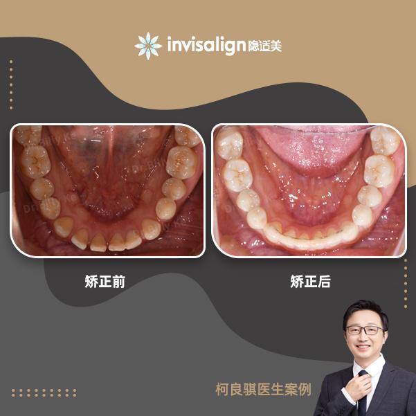 矫正结束:排齐整平牙列后,中线对齐,上下前牙得到内收,对前牙进行了覆