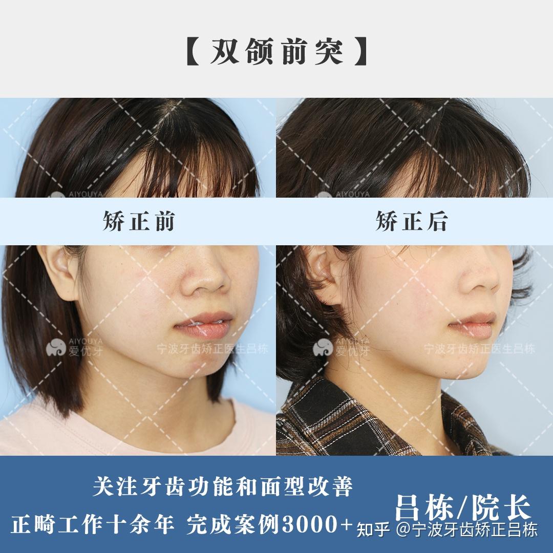 宁波牙齿矫正骨性牙性双颌前突矫正收获翘下巴