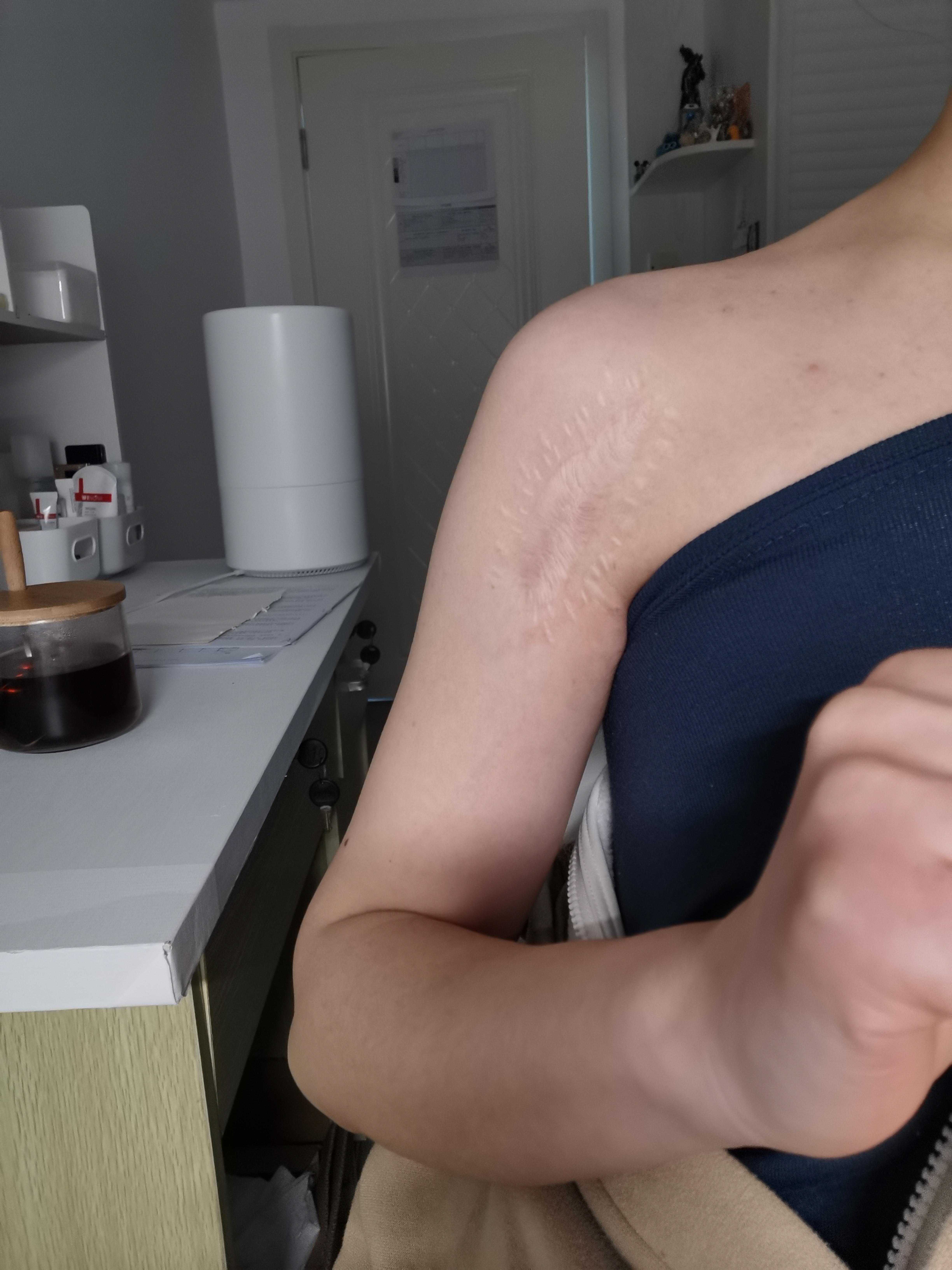 的疤拆了钢板也有一年半了疤越来越大且凸起有时痒不知是否疤痕增生