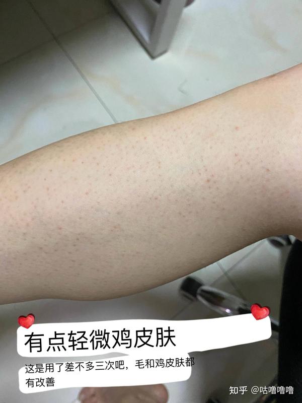 腿上鸡皮肤怎么消除干净(腿上鸡皮肤怎么消除怎么去除最有效) 腿上鸡皮肤怎么消除干净(腿上鸡皮肤怎么消除怎么去除最有效)
