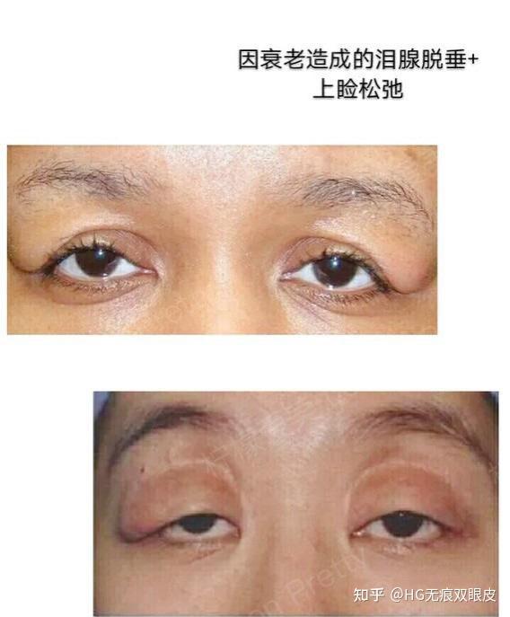 肿眼泡除了脂肪,肌肉,皮肤等问题外,还有一个元凶,那就是——泪腺脱垂