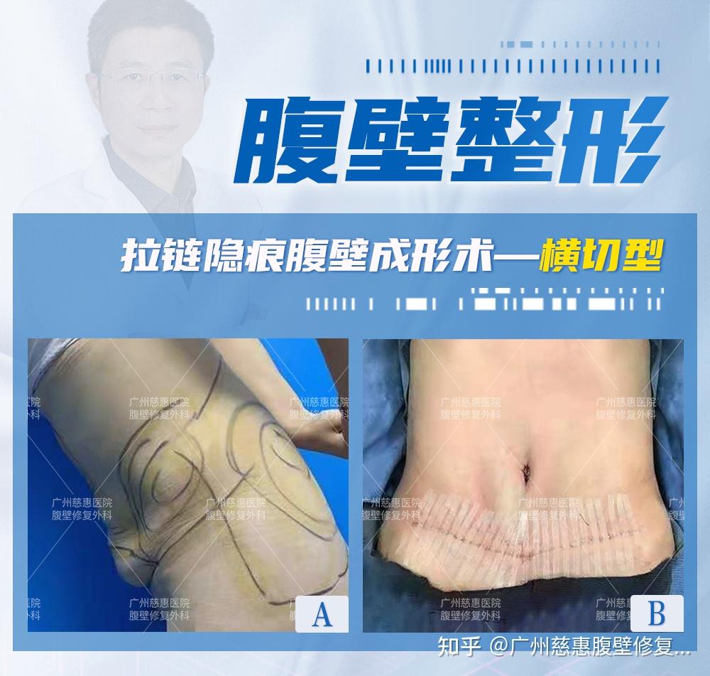 广州慈惠医院腹壁修复团队唐建兵主任:腹壁整形术对生活的影响?