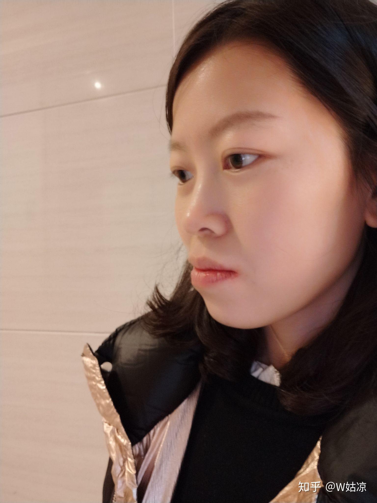 30岁高龄骨性地包天矫正