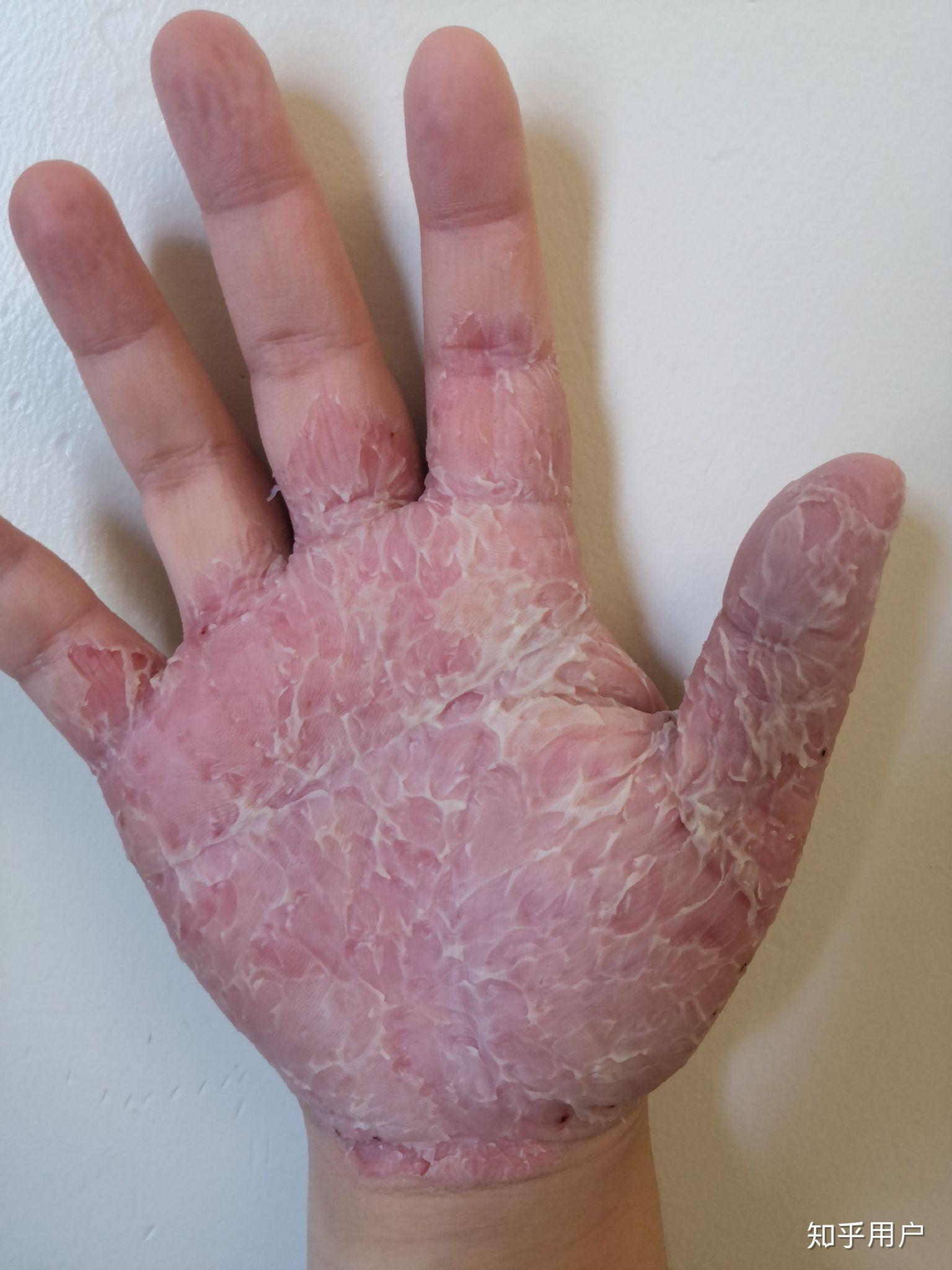 如何控制不自觉的没完没了的撕手皮如何恢复手指皮肤的状态比如已经撕