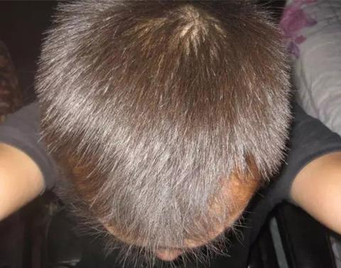 脱发