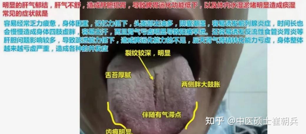 舌头上有裂纹?说明身体出了问题! - 知乎