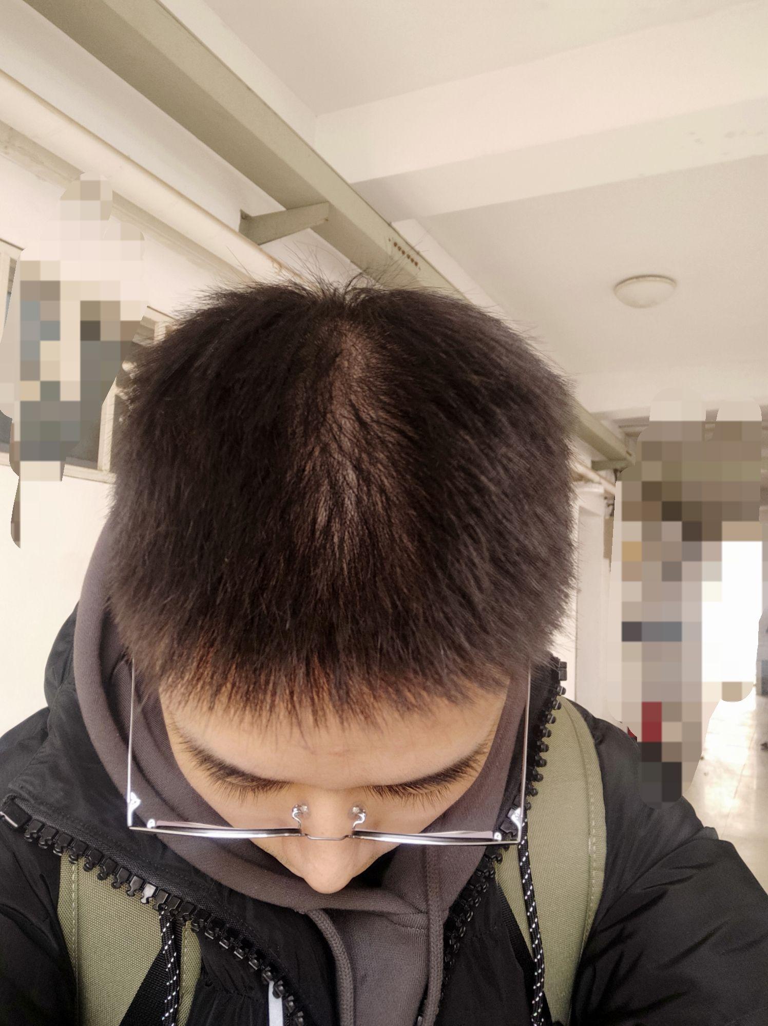 发旋处头发太少了！！！，我是不是要秃了，怎么办啊！？ - 知乎