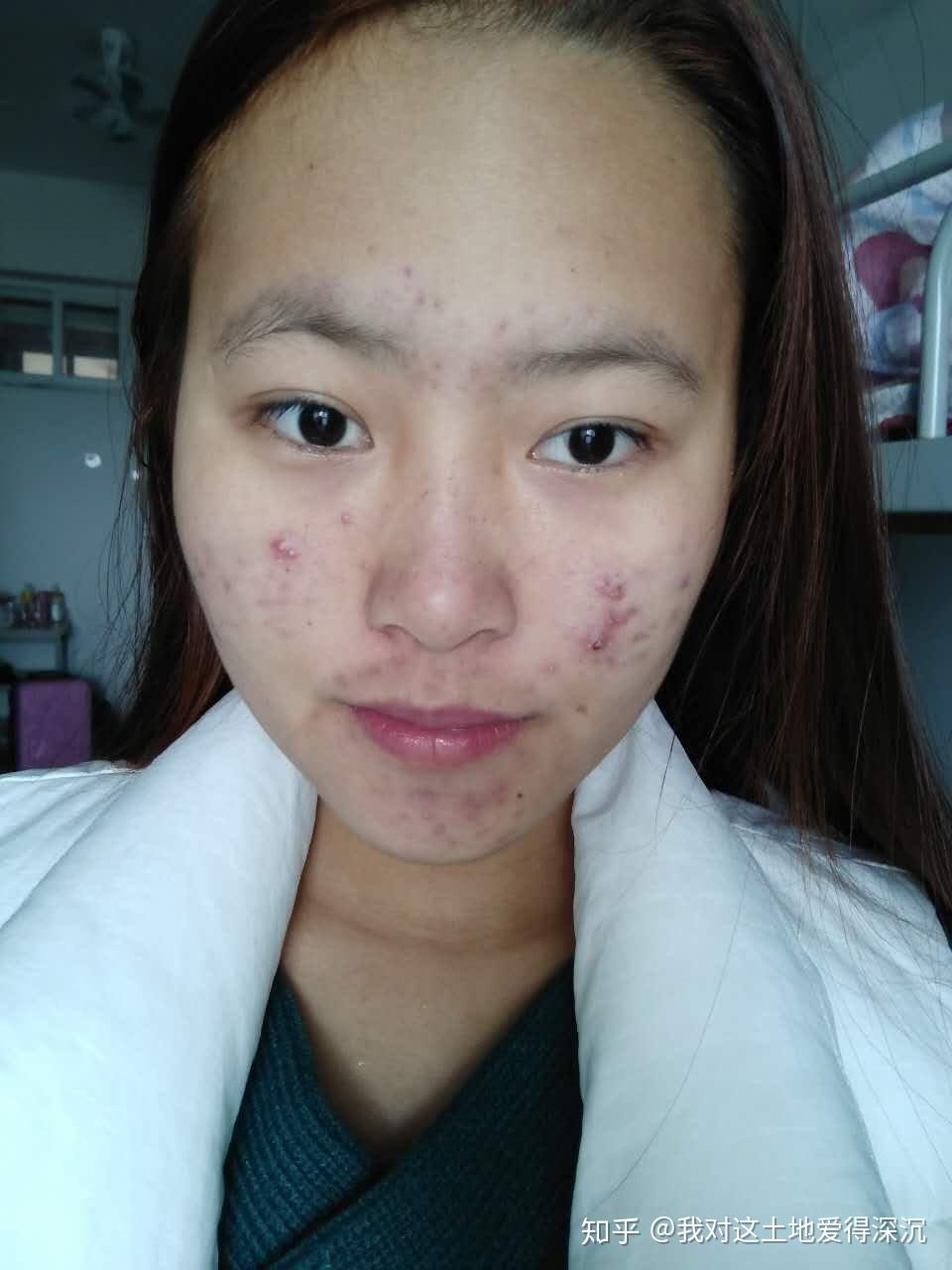怎样才能不长闭口粉刺 v2-3c299b4b9248f2c6212baa17f6555415_r.jpg