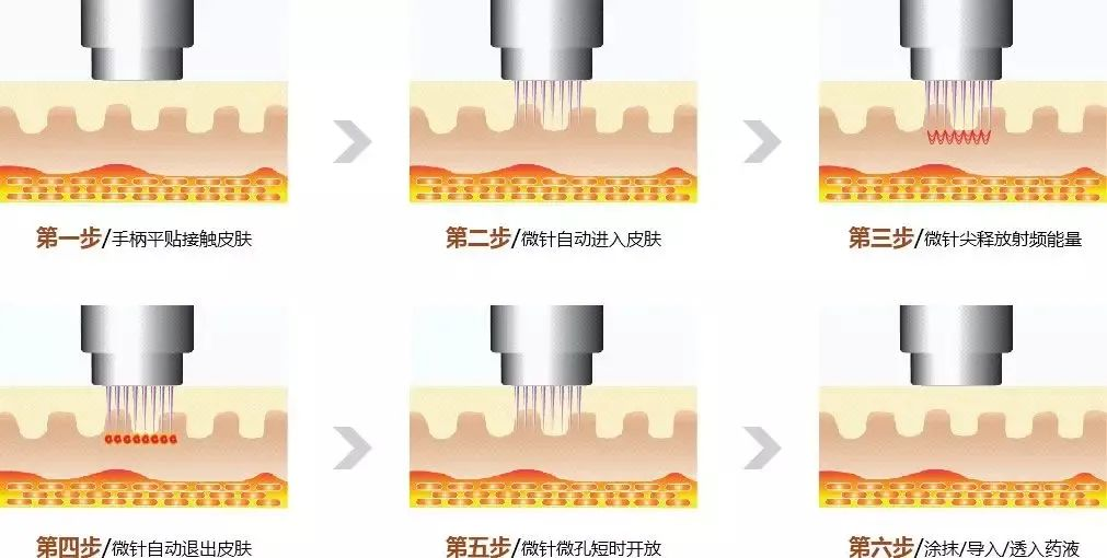 微针射频在皮肤年轻化、痤疮和痤疮瘢痕等临床应用规范详解 - 知乎