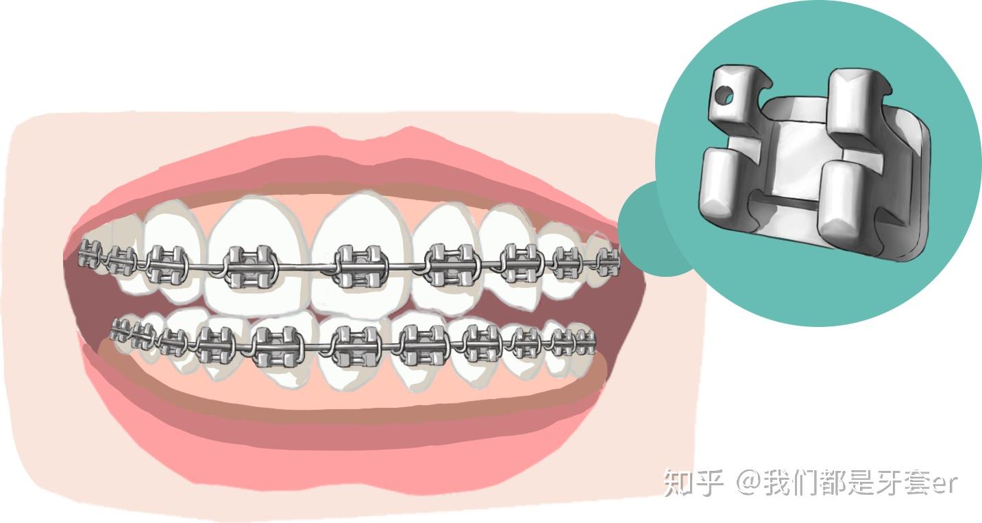 正畸攻略牙套种类优缺点大pk两分钟教你如何选择适合自己的牙套