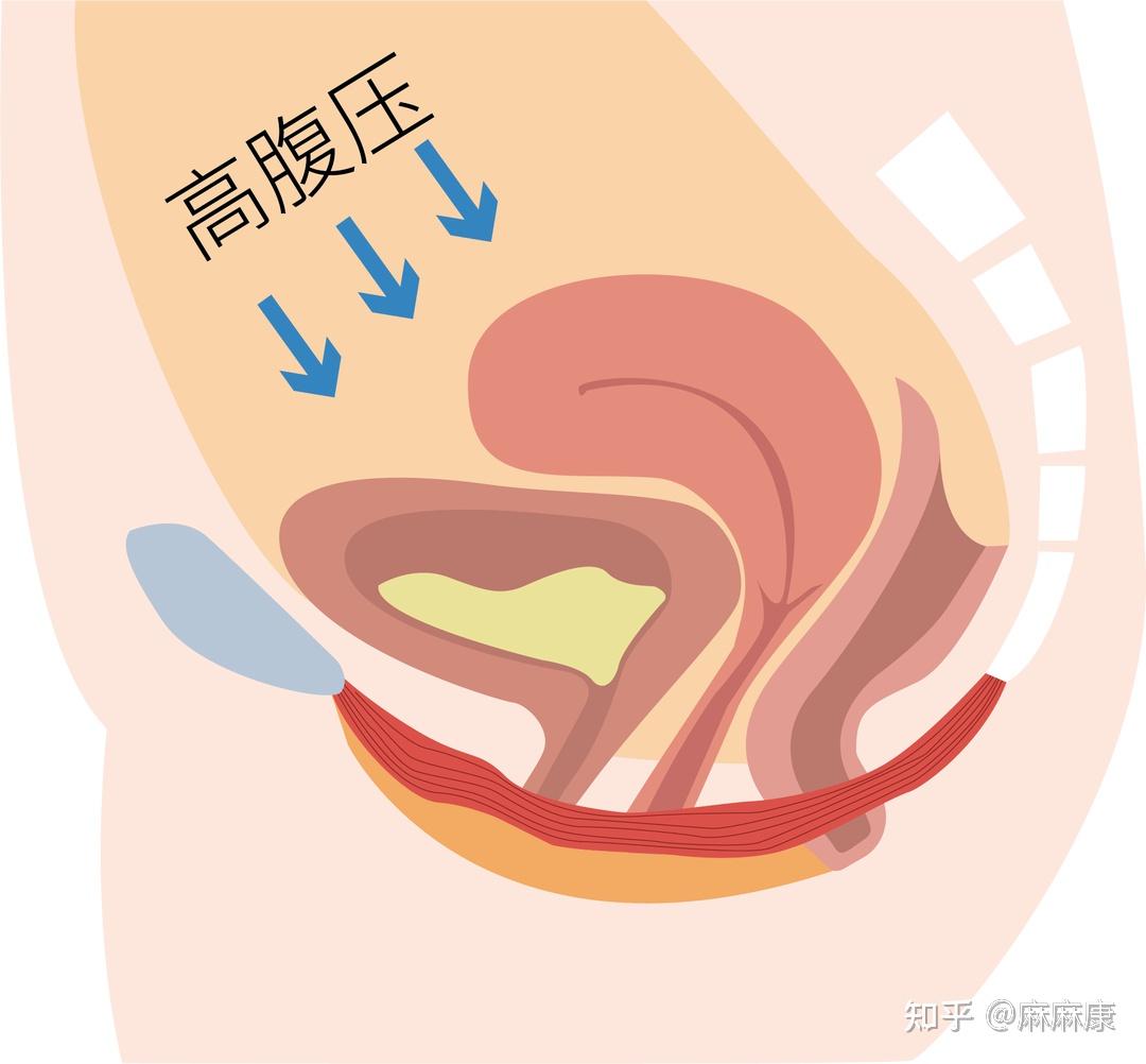 在所有因素中,怀孕分娩是导致女性盆底肌受损最主要的原因.