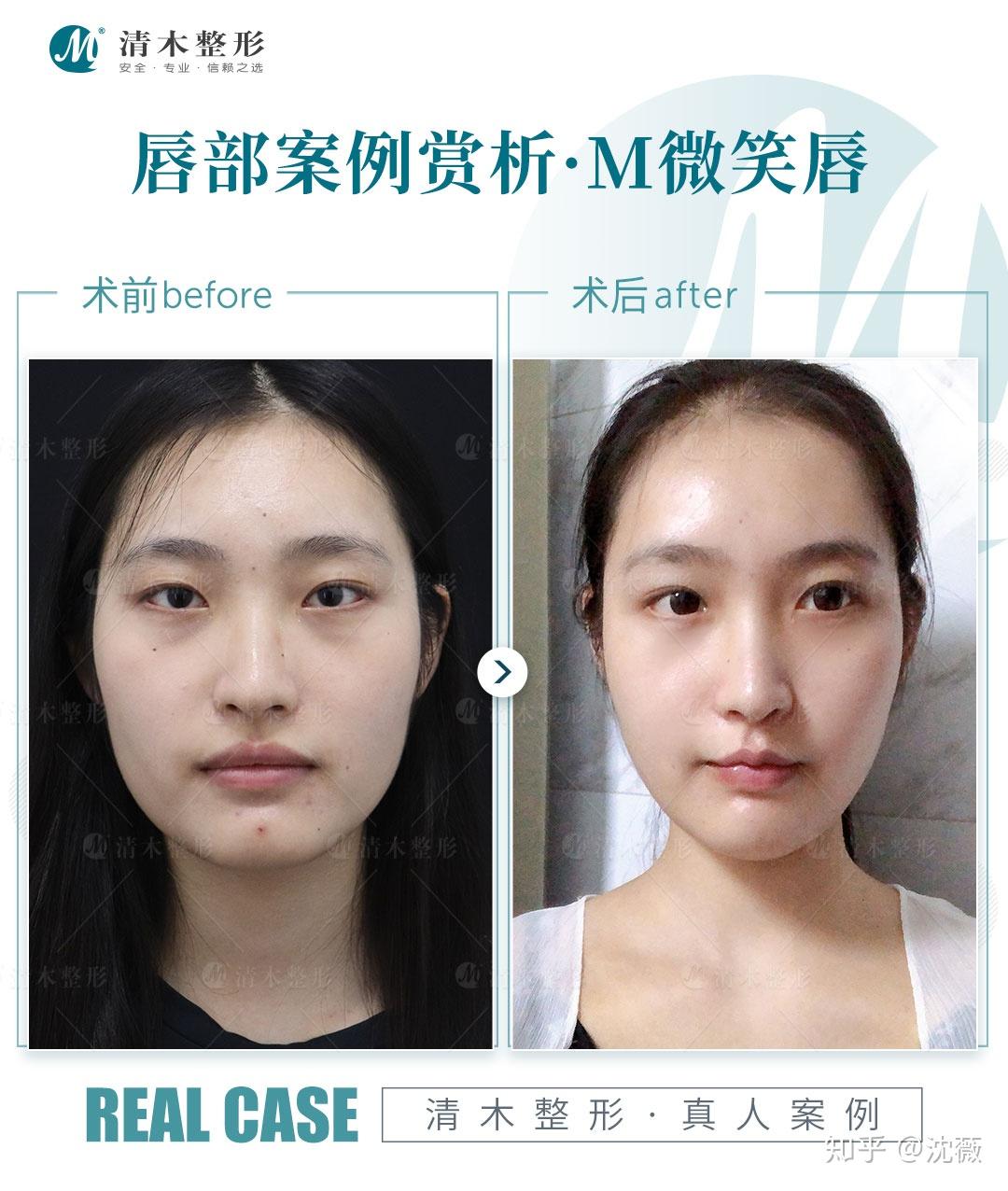 但有的人说做了嘴角上扬手术后感觉嘴巴变大了